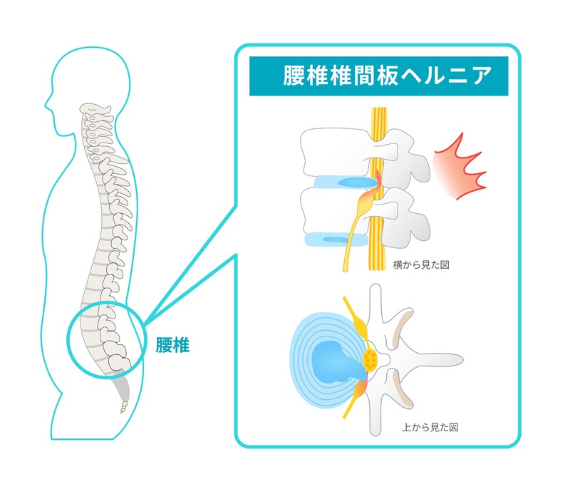 腰椎椎間板ヘルニア　イラスト